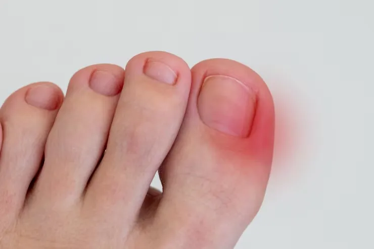 Cirurgia na unha do pé​