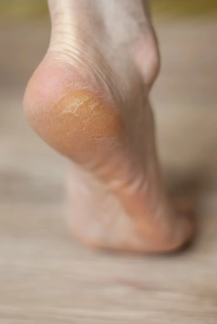Fissuras nos pés tratamento