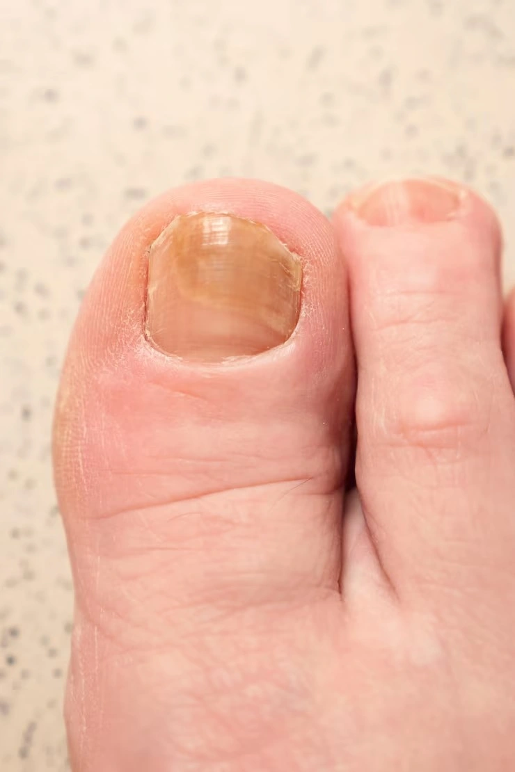 Onicocriptose tratamento podológico