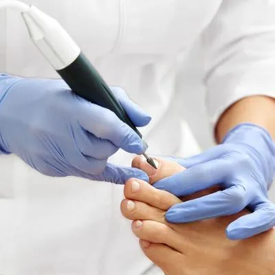 Onicocriptose tratamento​