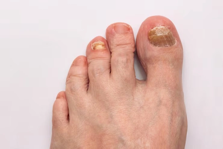 Podologia fungo nas unhas