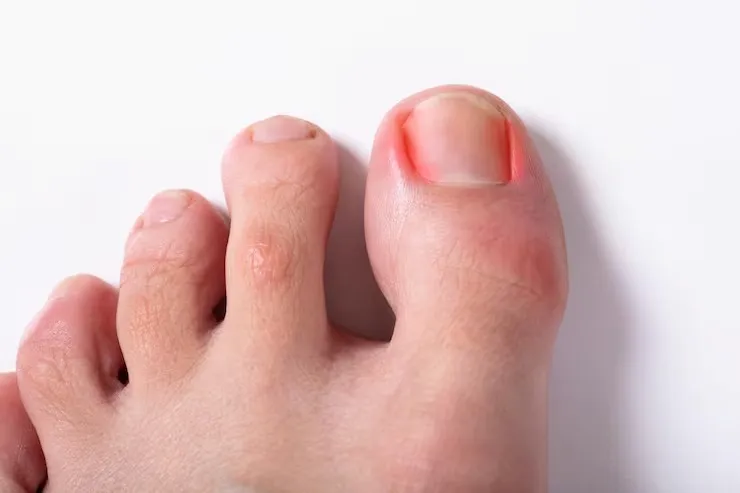 Podologia para pés diabéticos​