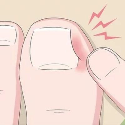 Tratamento para onicocriptose em Osasco