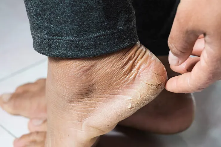 Tratamento para rachadura nos pés​