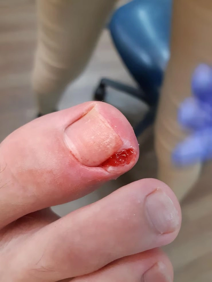 Tratamento para unha infeccionada