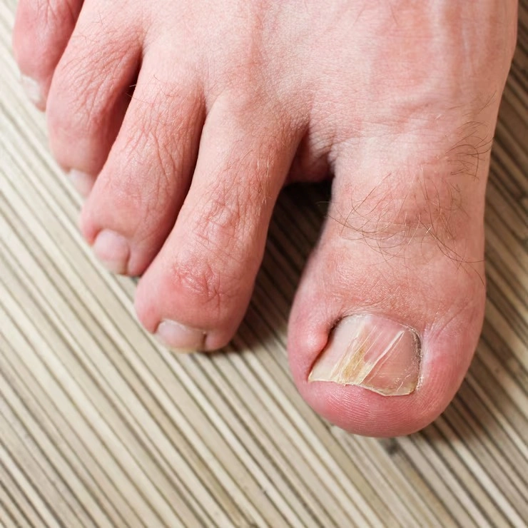 Tratamento para unha infeccionada nos pés diabéticos