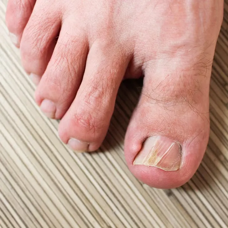 Tratamento para unha infeccionada nos pés diabéticos​