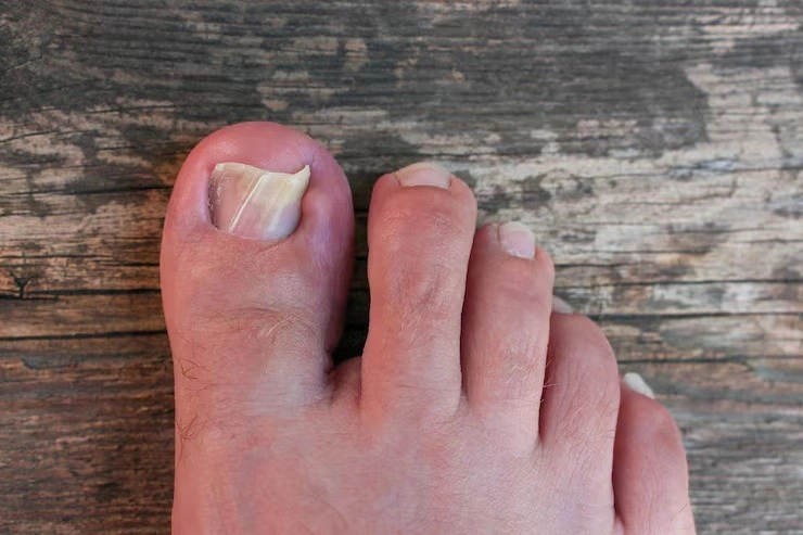 Tratamento para unhas encravadas e inflamadas