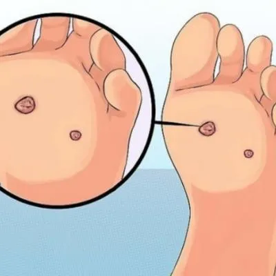 Tratamento para verruga plantar​