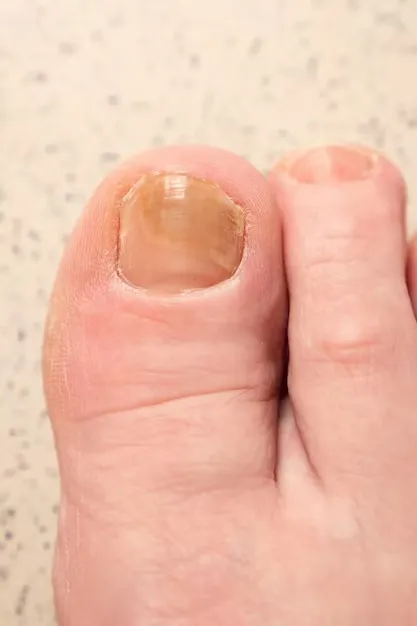 Unha encravada tratamento onicocriptose​
